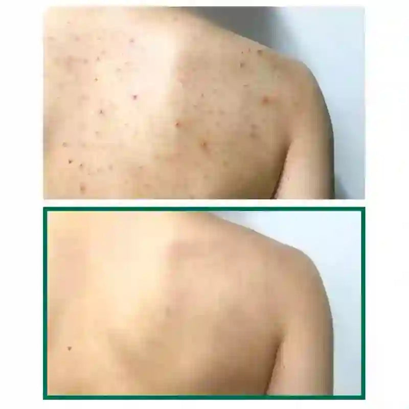 Some By Mi Acne Clear Body Cleanser 400ml — product image 4