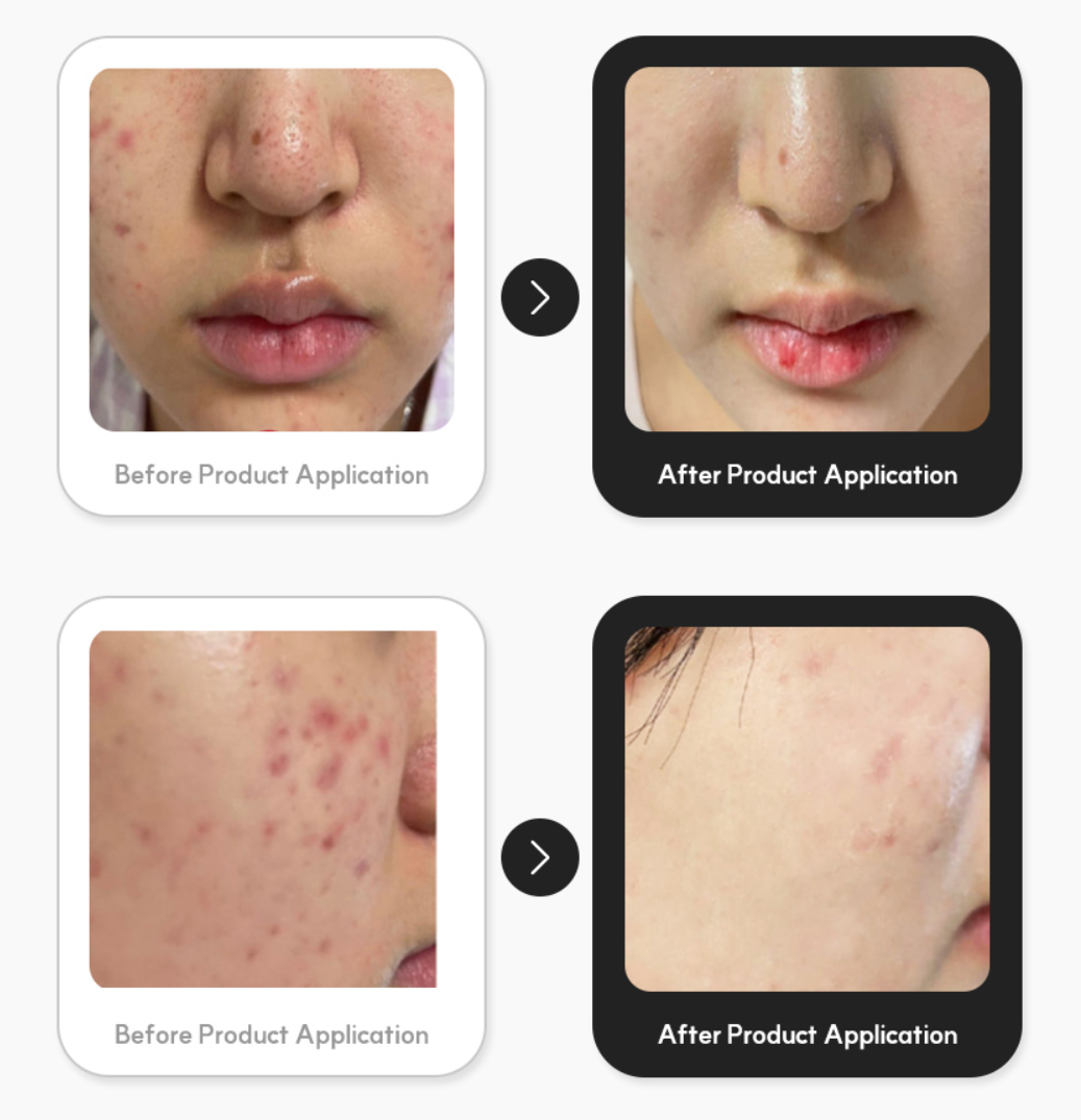 VENDERMA Red Calming Cica Exosome 2 Weeks Intensive Care Program Set — product image 6
